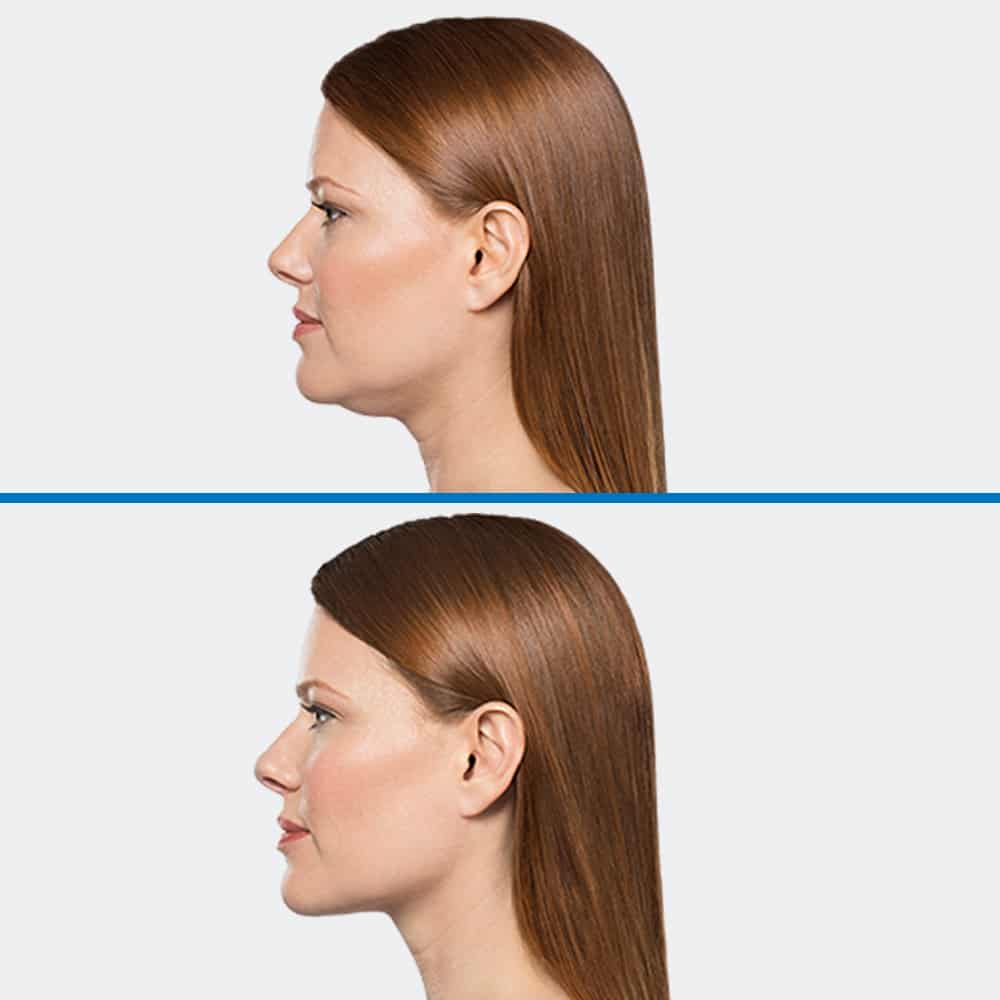 before after kybella option2 b