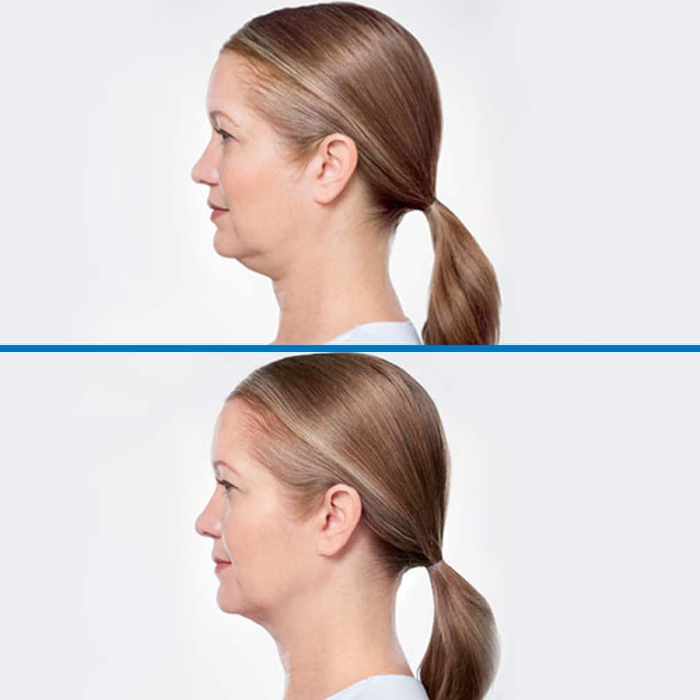 kybella before after option 2