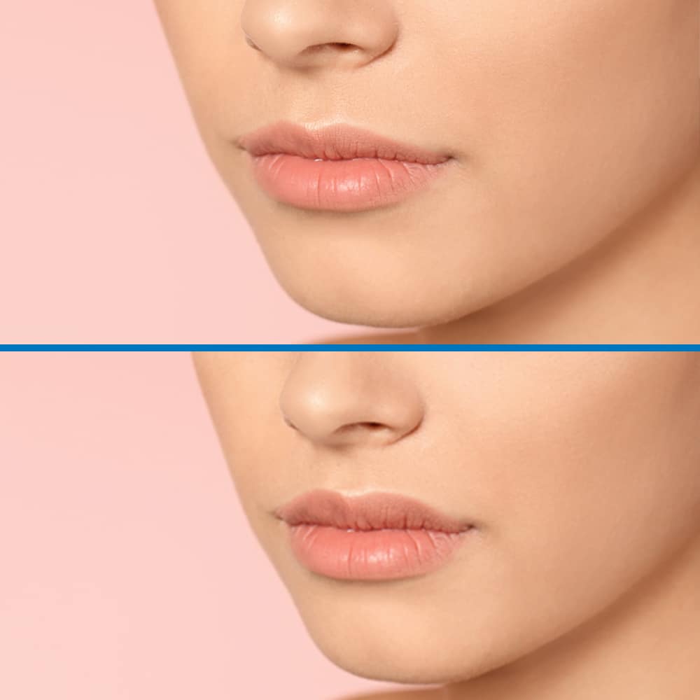 lips before after