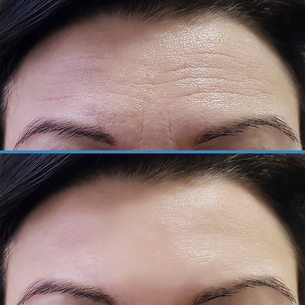 silk before after forehead botox