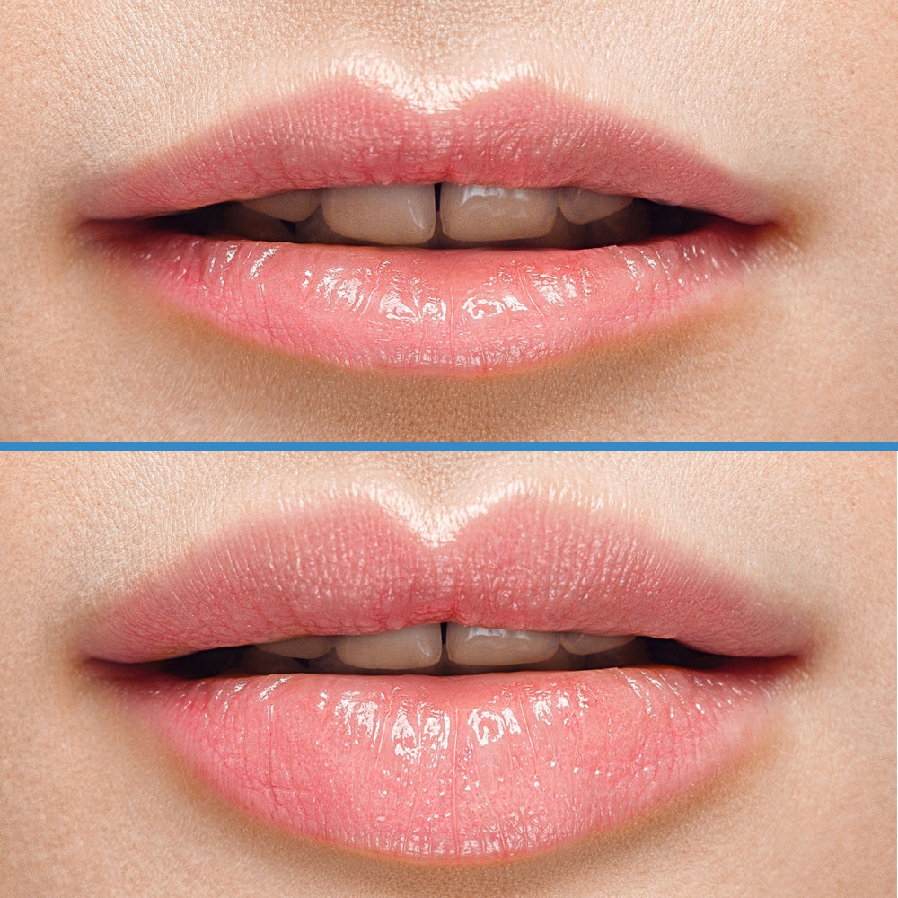 silk before after lip fillers