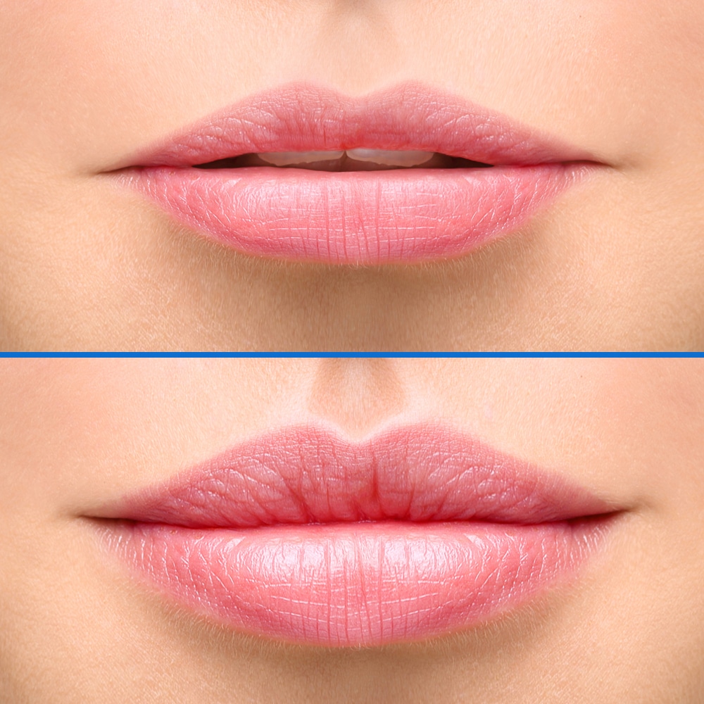 silk lips before after