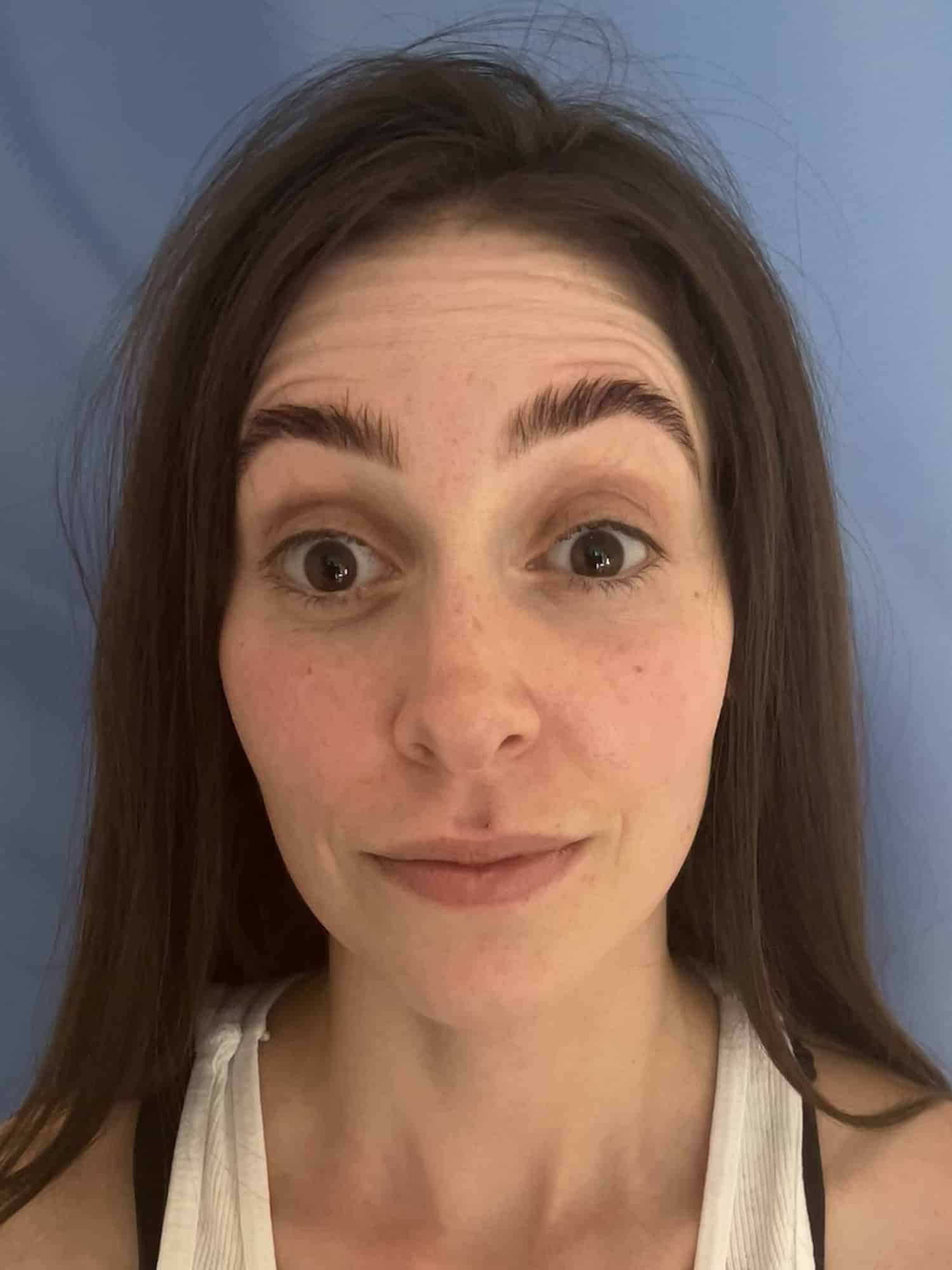 Before Image: Injectables - front