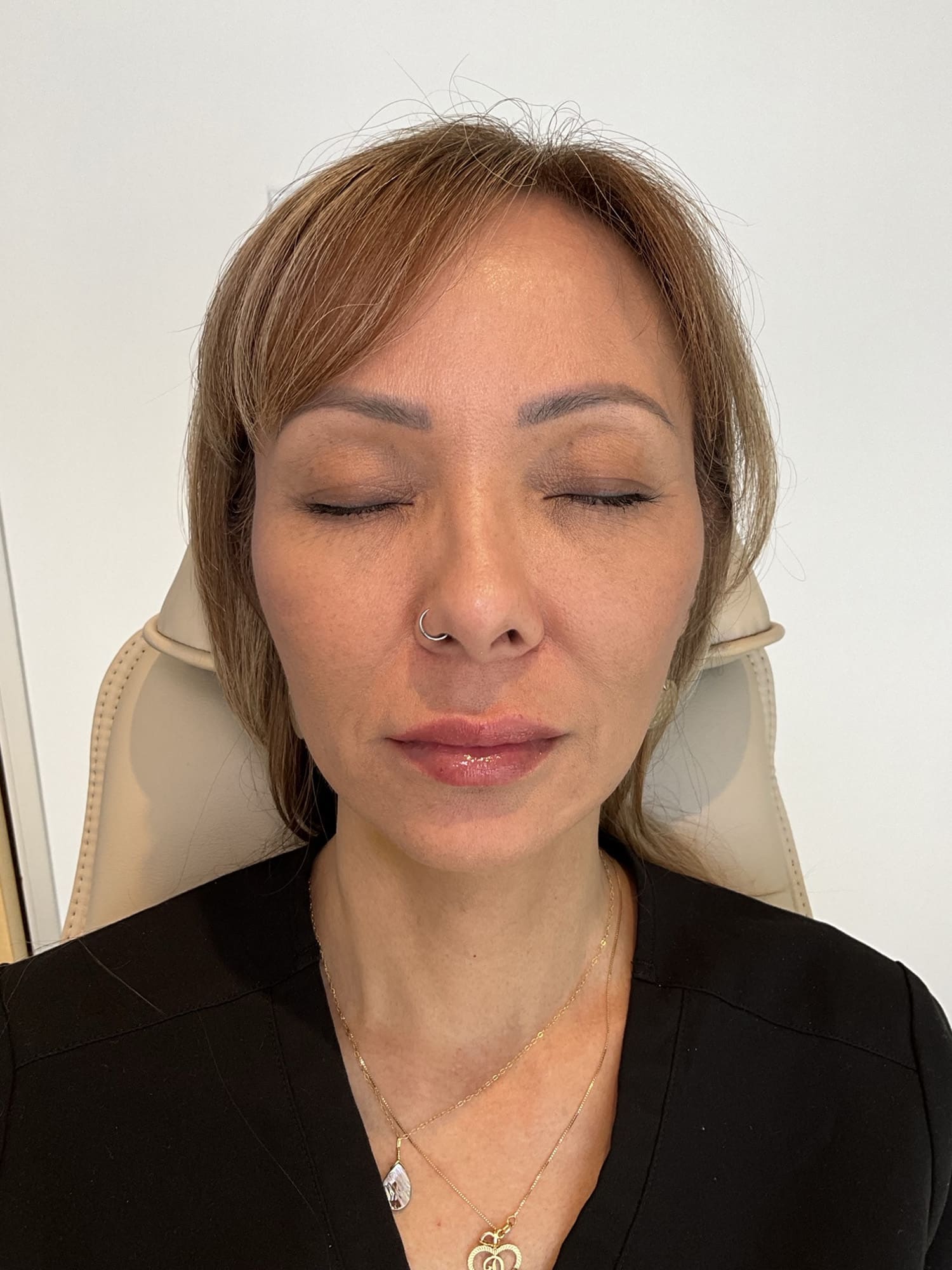 After Image: Fillers - front