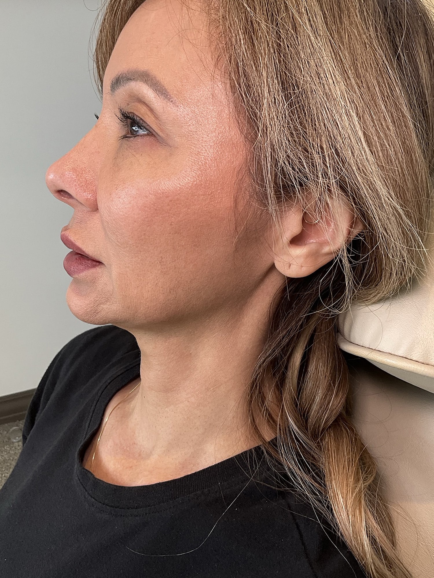 After Image: Injectables - left-front-oblique