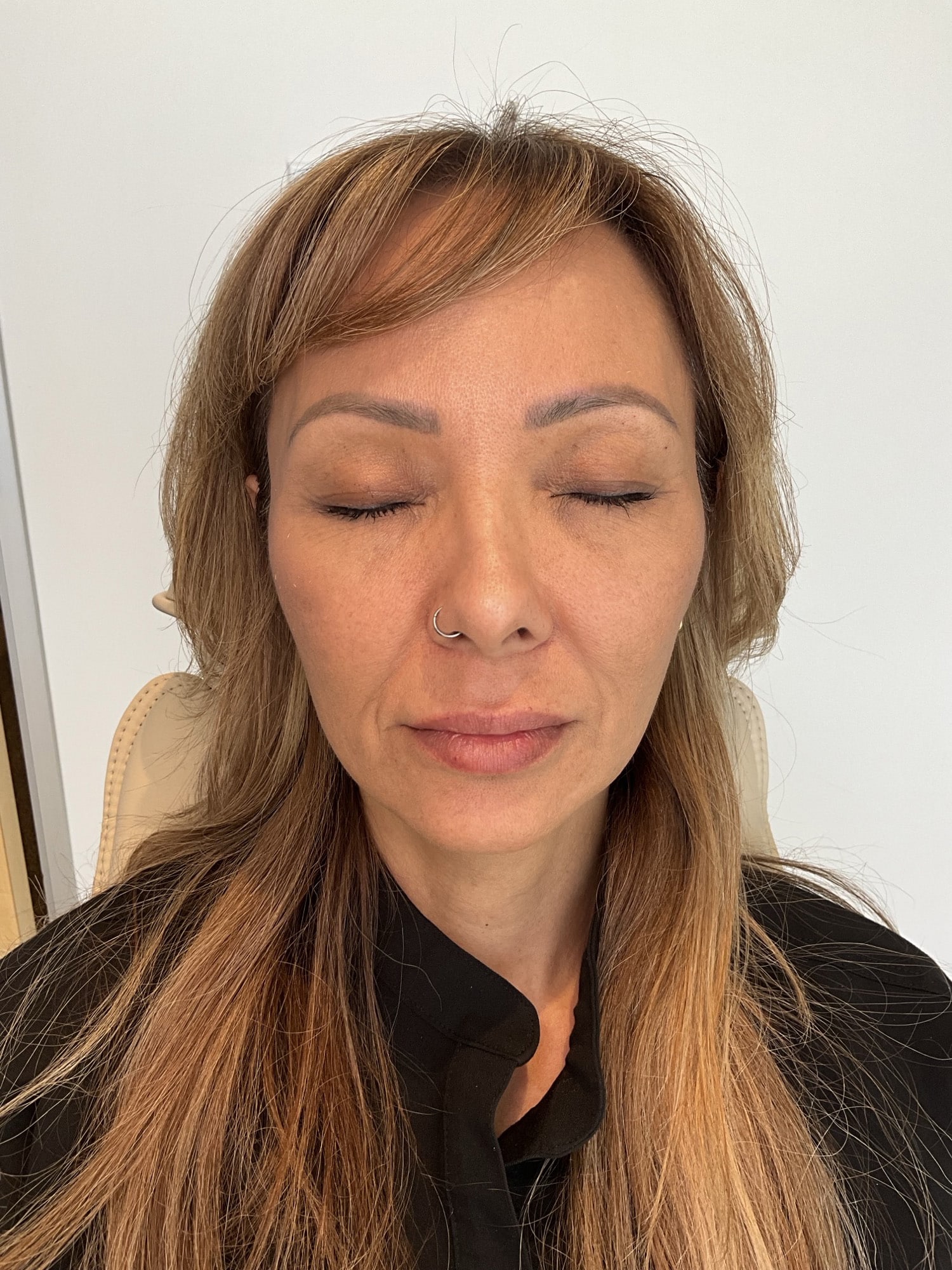 Before Image: Fillers - front