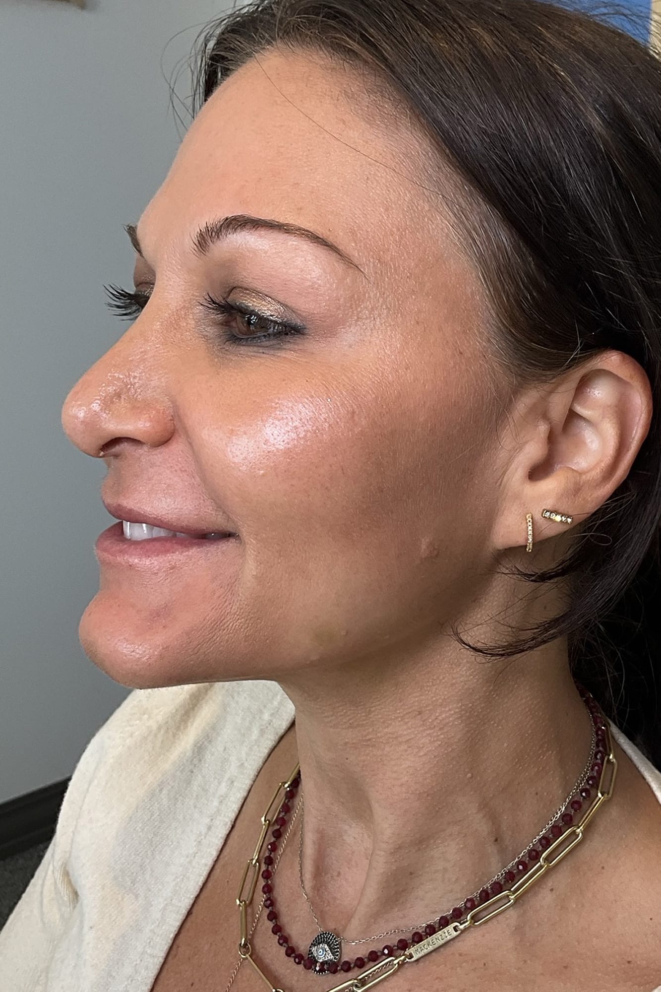 After Image: Injectables - left-front-oblique