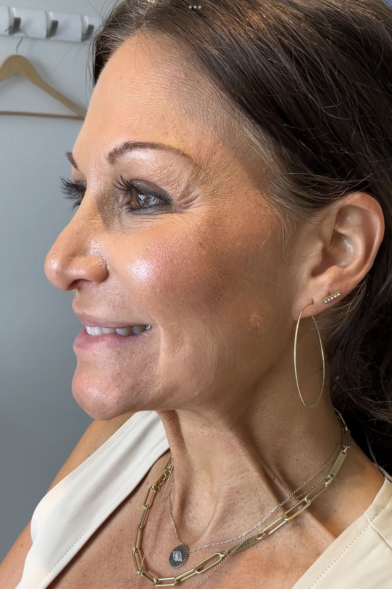 Before Image: Injectables - left-front-oblique